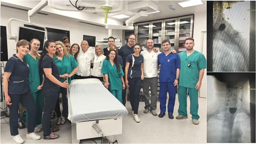 Zavod za gastroenterologiju KBC-a Split uveo Z-POEM zahvat, novu endoskopsku metodu liječenja