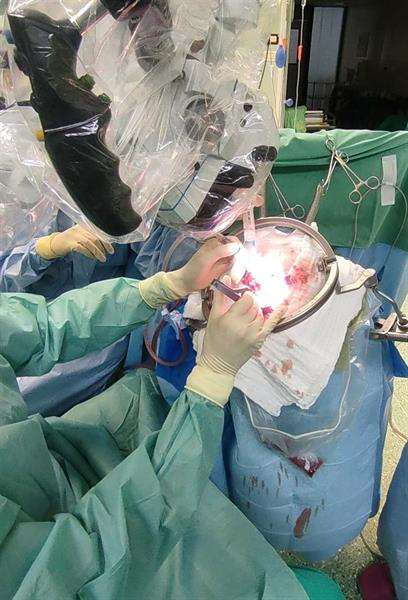 Nakon 15 godina u KBC-u Split uspješno obavljena operacija moždane aneurizme
