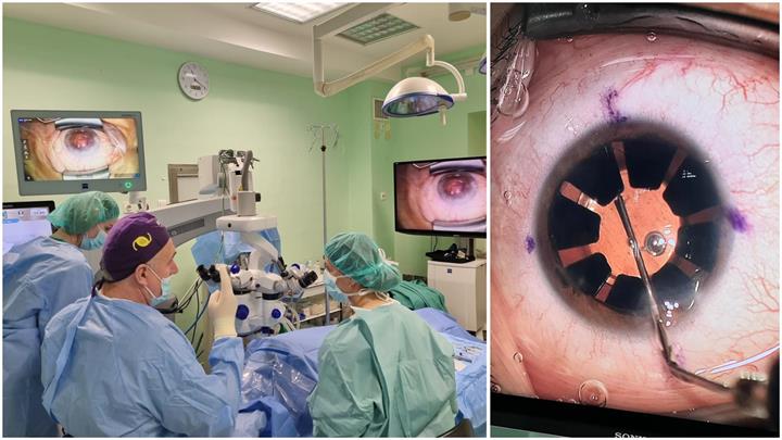 Klinika za očne bolesti KBC-a Split: Prvi put implantirana umjetna šarenica pacijentici koja je rođena bez nje