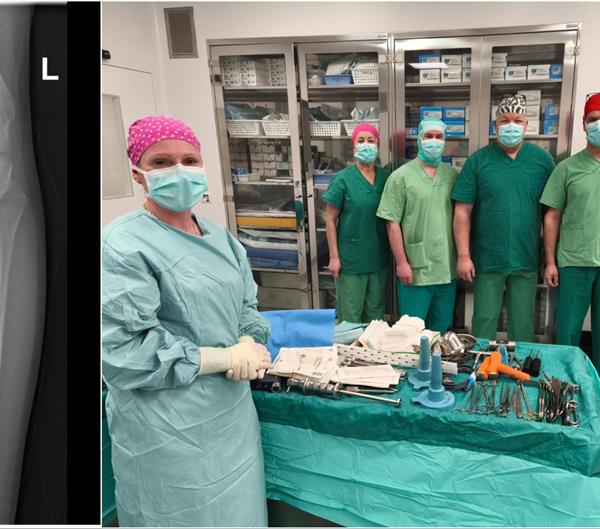 Na Zavodu za ortopediju i traumatologiju po prvi put odstranjen maligni tumor osteosarkoma tibije