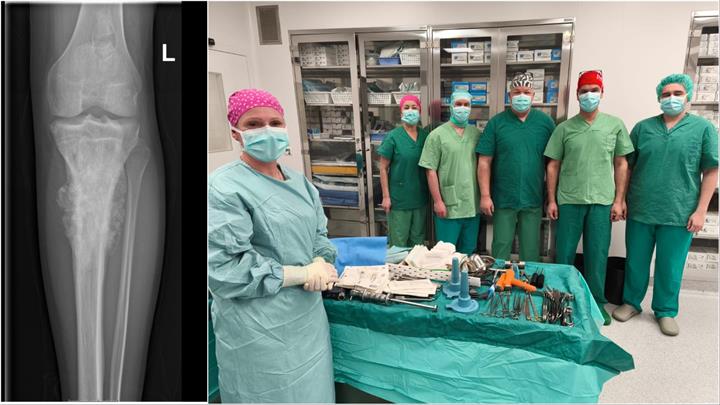 Na Zavodu za ortopediju i traumatologiju po prvi put odstranjen maligni tumor osteosarkoma tibije
